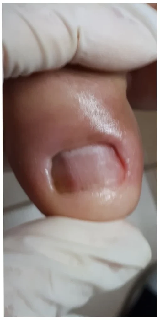 Estrutura ungueal — Depois