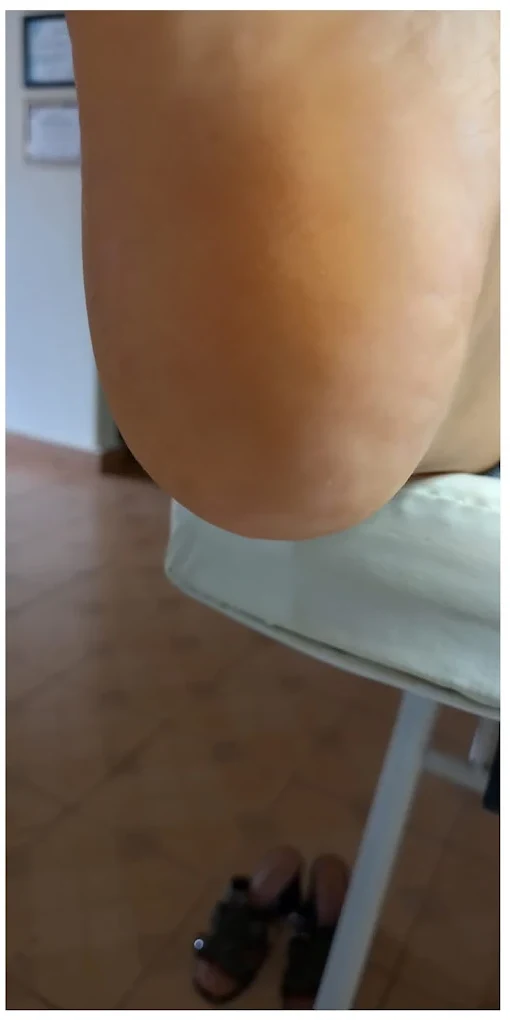 Desbaste plantar — Depois